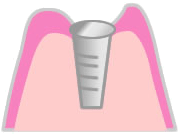 インプラントの埋め込み